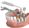 Waldent Dental Implant Prosthetic Universal Kit