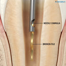 Waldent Needle Cannula For EndoResQ File Retrieval System (Pack Of 3) - Image 4