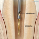 Waldent Cutting Drills For EndoResQ File Retrieval System (Pack Of 3)