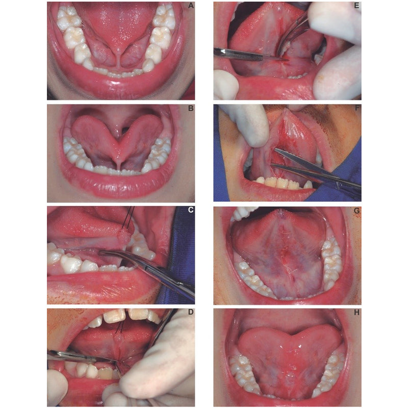 Waldent Hemostats ( Artery Forcep)