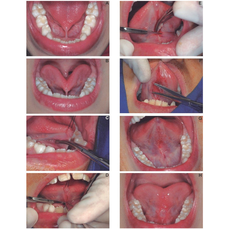 Waldent Hemostats ( Artery Forcep)