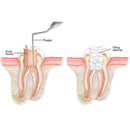 Waldent Dual-Ended Endodontic Plugger/Condenser Kit - Assorted (Pack of 4) - Image 4