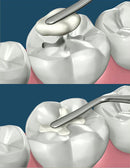 Waldent Composite Filling Instrument - Silicon Handle - Image 8