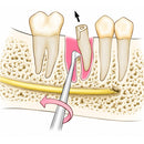 Waldent Cryer Root Elevator - Set View 5