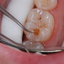 Waldent Lucas Bone Curettes - Set of 5 (K15/10) - Image 6