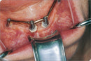 Waldent Minnesota Retractor with Suction Tube (8/143) - Image 4