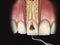 Waldent Root Canal Pluggers