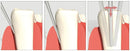 Waldent Luxator Set Of 4 (K11 /1)