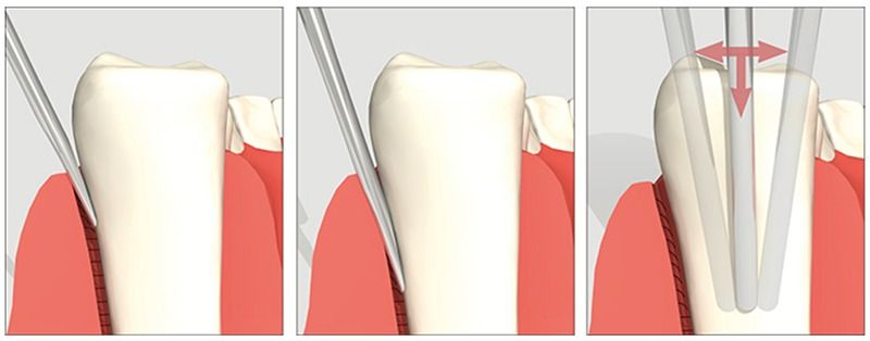 Waldent Luxator Set Of 4 (K11 /1)