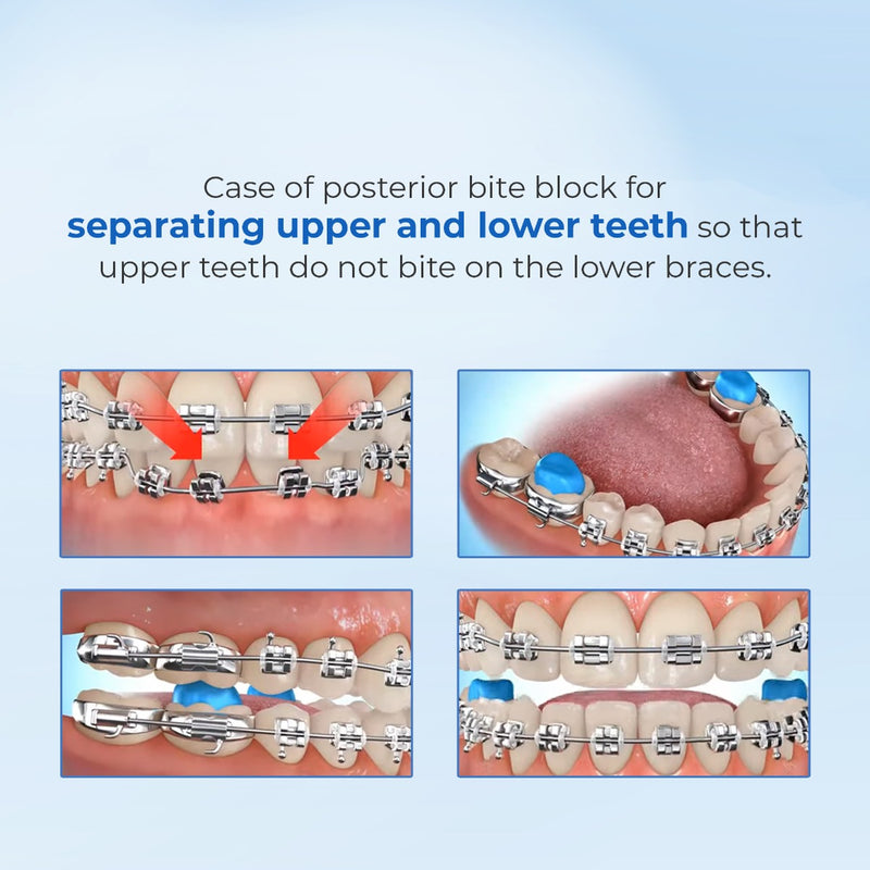 Blocks Teeth Bite Blocks Keep Falling Off at Kenneth Mcgray blog