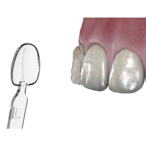 Waldent MyVeneer Composite Template System