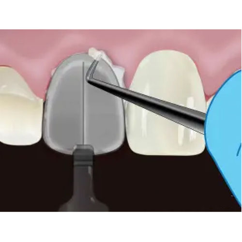 Waldent MyVeneer Composite Template System