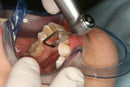 Waldent Orthodontic Inter-Proximal Reduction (IPR) Kit