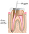 Waldent Root Canal Pluggers Set of 6 (K15/3)